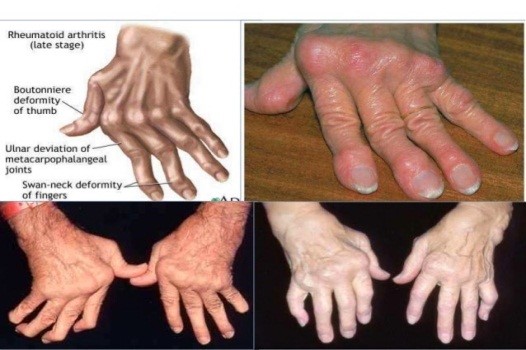 Can leprosy be treated?