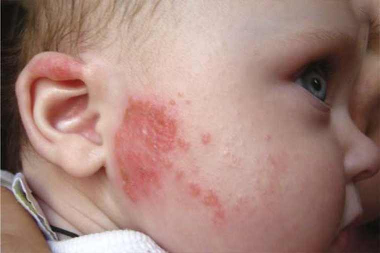 Treatments for Atopic Dermatitis and Eczema in Children