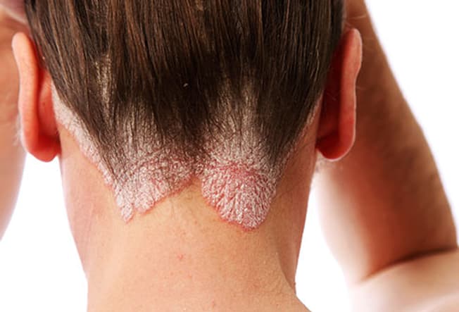 Bệnh vẩy nến da đầu - Những điều bạn cần biết
